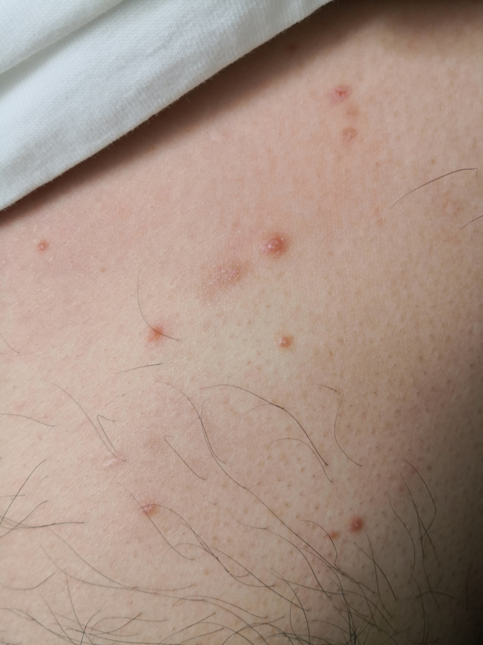 前胸传染性软疣并发踝部斑块状湿疹.#传染性软疣##湿疹