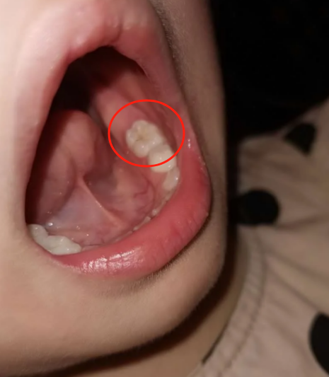 细菌会慢慢腐蚀牙齿,先损坏牙釉质,然后形成空洞