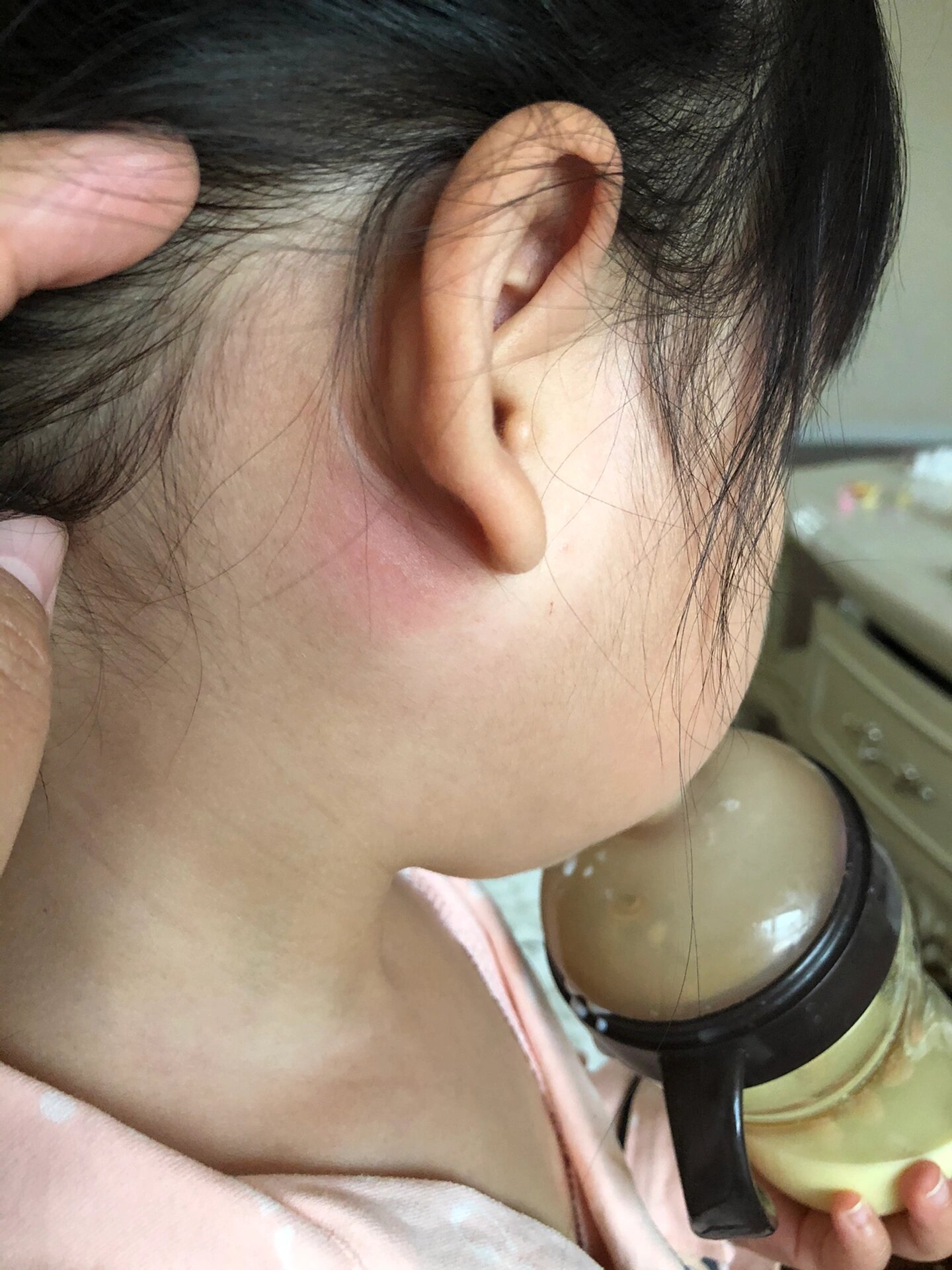 娃反复性腮腺炎