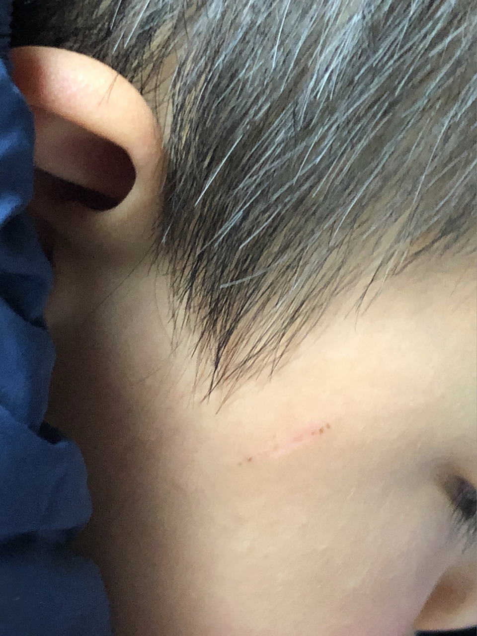 被邻居小孩指甲抓破了,今天一周了,结痂脱落后凹陷了,这种会留疤痕