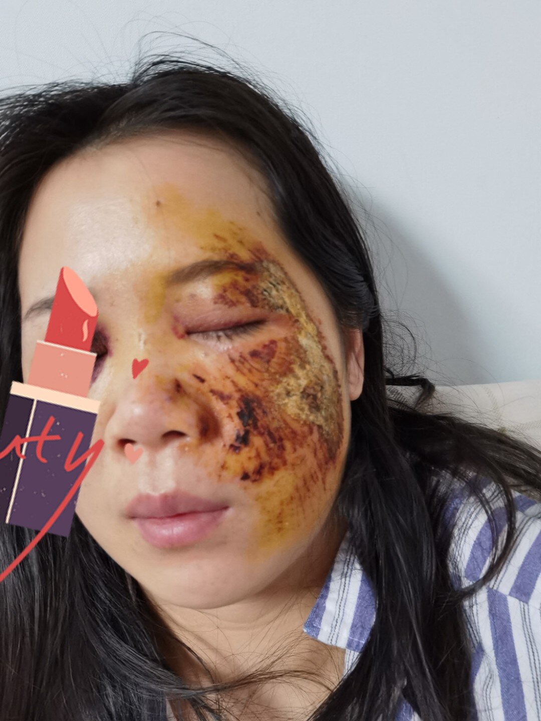 脸部擦伤第4到7天 这几天天天涂碘伏,结痂的那边会发烫发痒,一痒我就