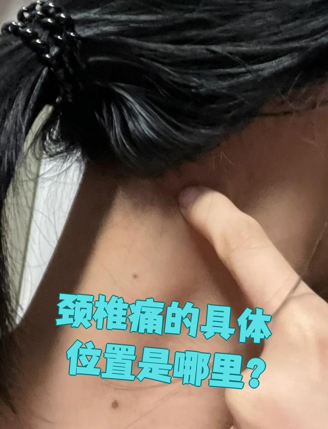 颈椎痛最常见的位置是颈后部,也就是脖子后面