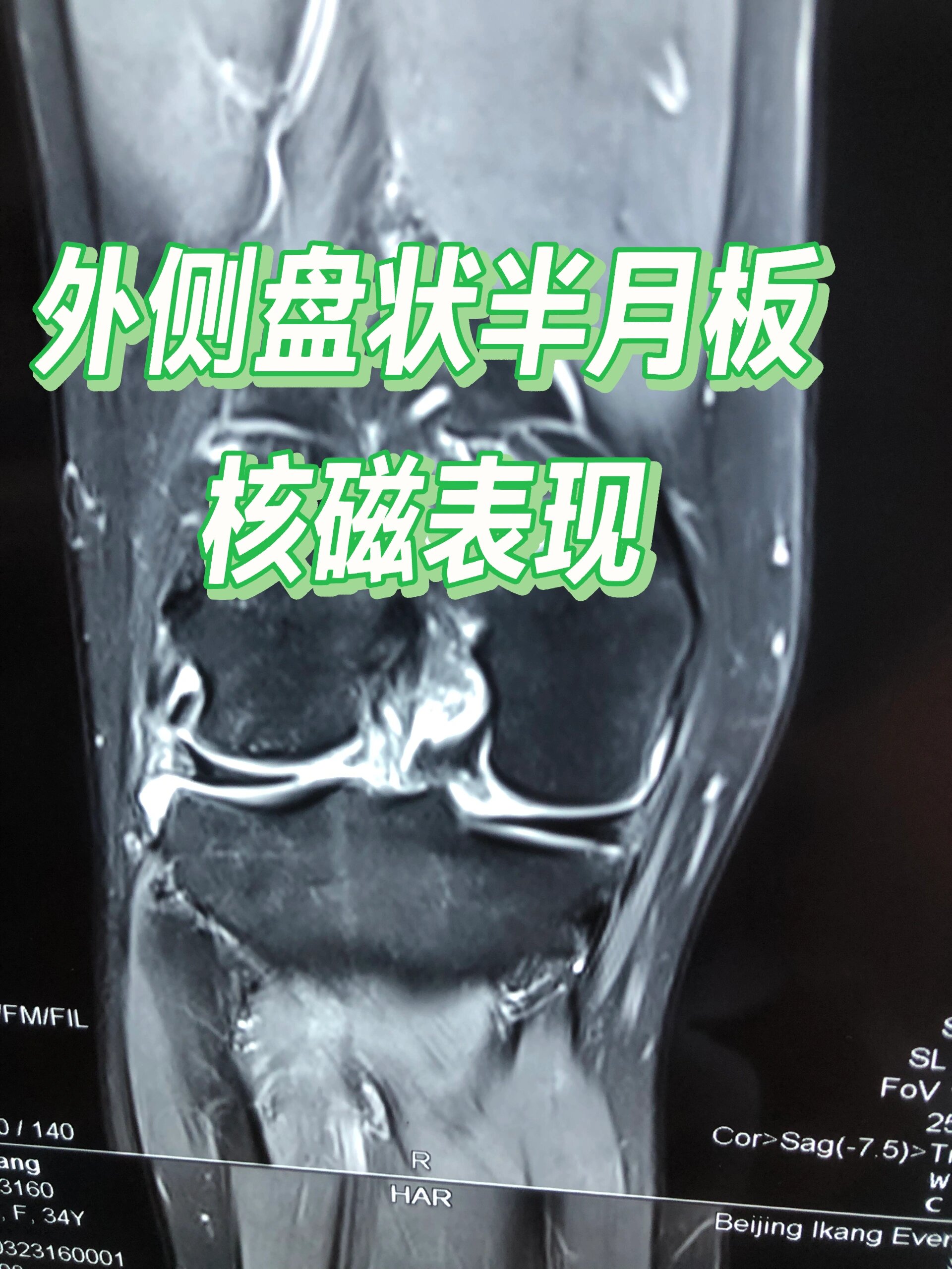 外侧盘状半月板损伤核磁表现 今天两台手术之一,外侧盘状半月板损伤