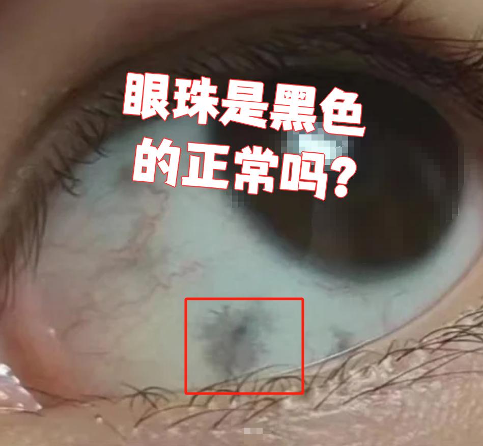 眼珠是黑色的,这通常是正常的