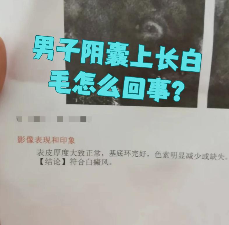 阴囊上长白毛可能和年龄增长,营养不良,白癜风这些原因有关