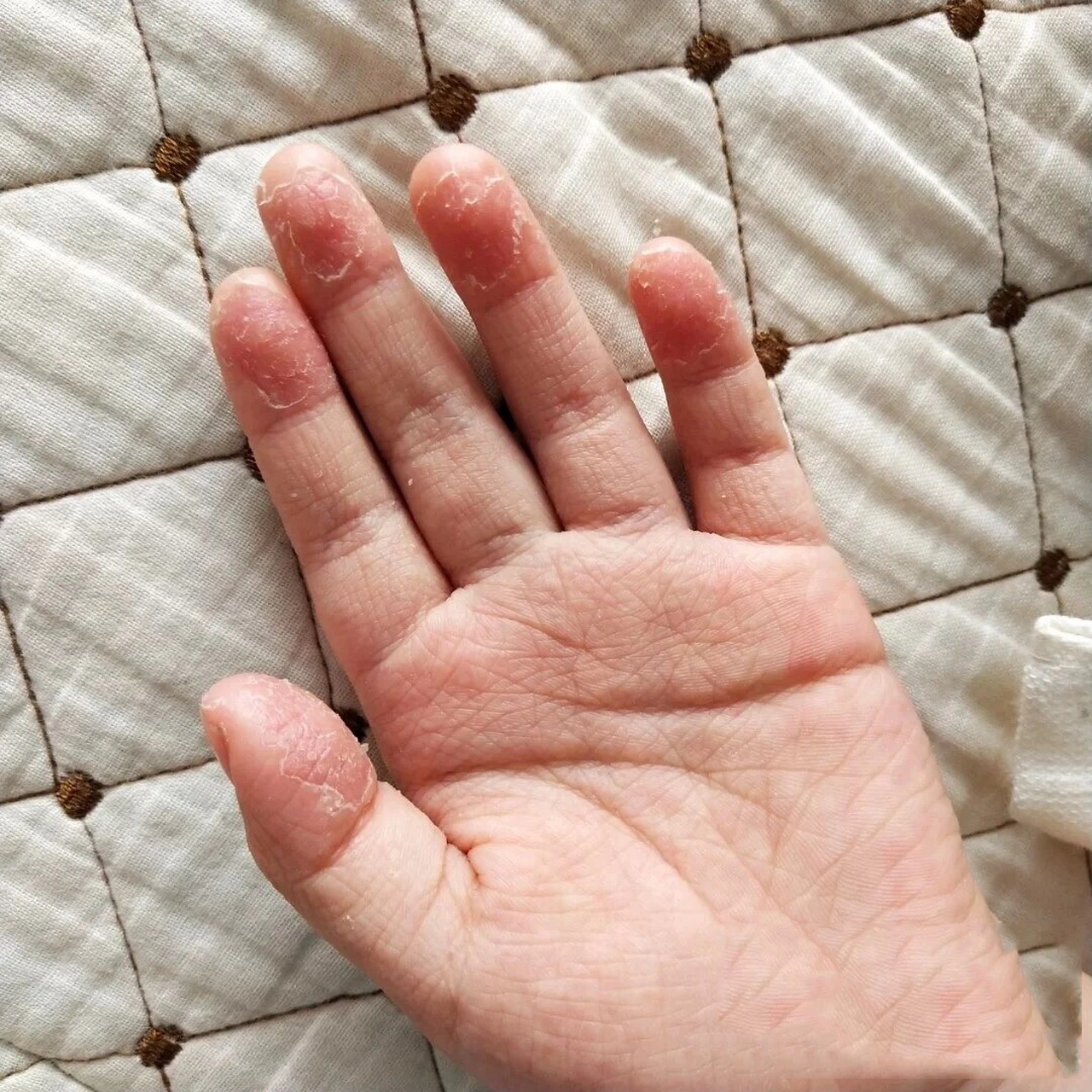 小孩手指脱皮好了 我家哥哥8岁了,近两年手指一直有偶尔脱皮,但是没有