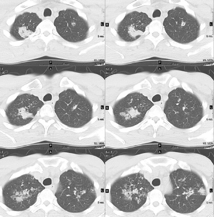 病例1 双肺多发结节 男47岁,胸闷,胸痛,咳嗽,发热10余天;家庭常年行