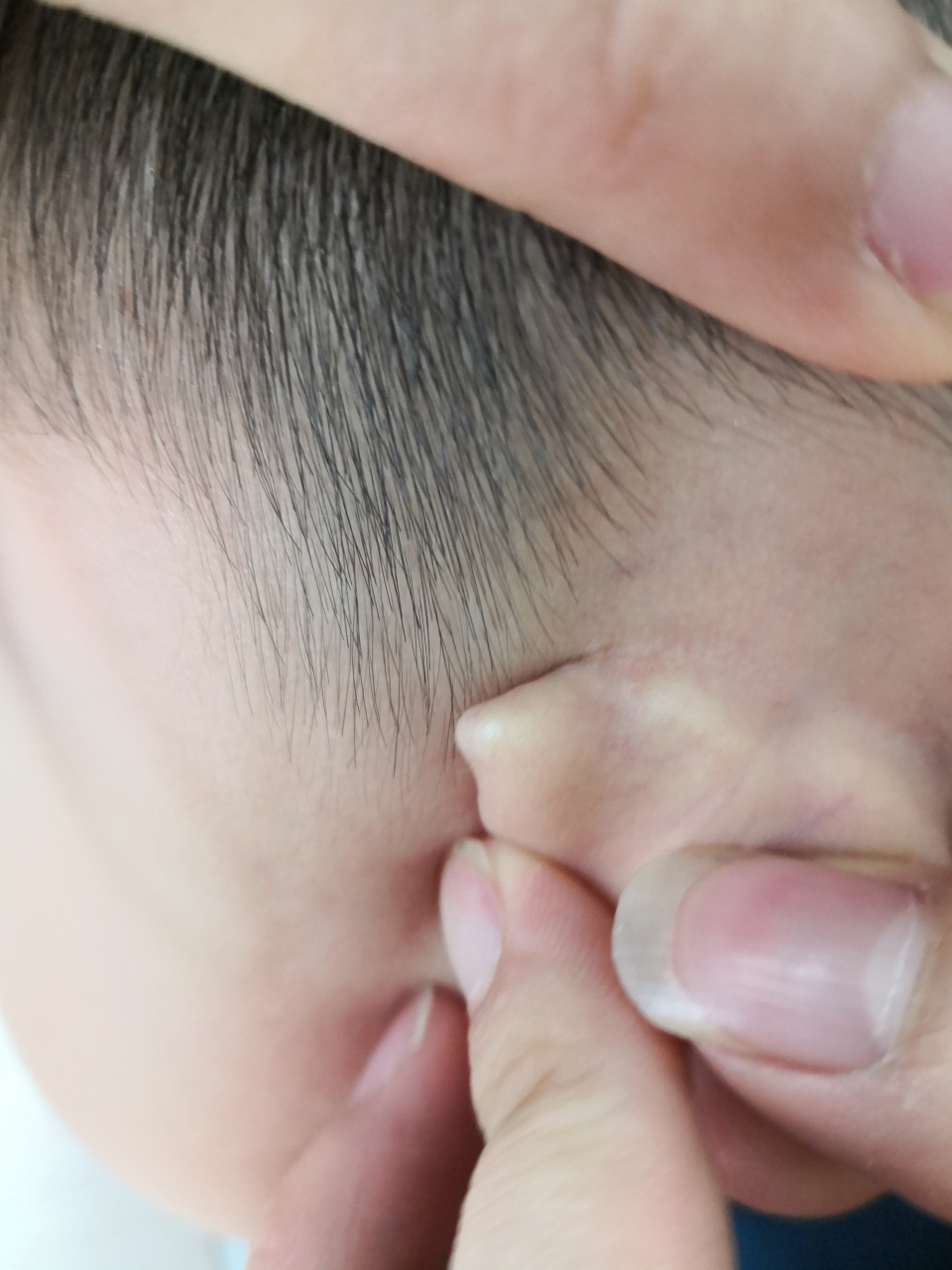 儿童面部躯干部位的传染性软疣症状#传染性软疣# 可以使用药物治疗