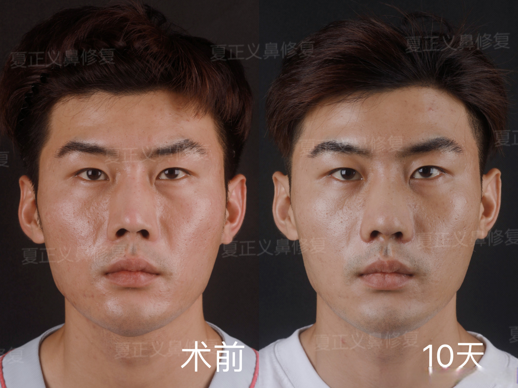 术中取出原假体,重新雕刻膨体改善鼻梁宽度,鼻小柱矫正,宽鼻矫正