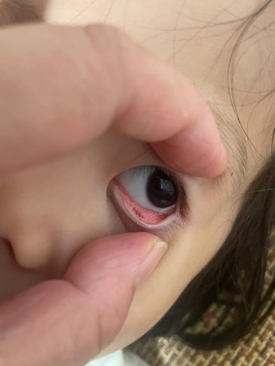 小孩下眼皮里面长很多一个个小水泡小疙瘩 是什么原因,眼睛还很红