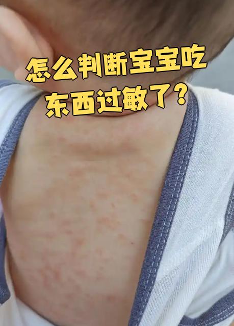 怎么判断宝宝吃东西过敏了?