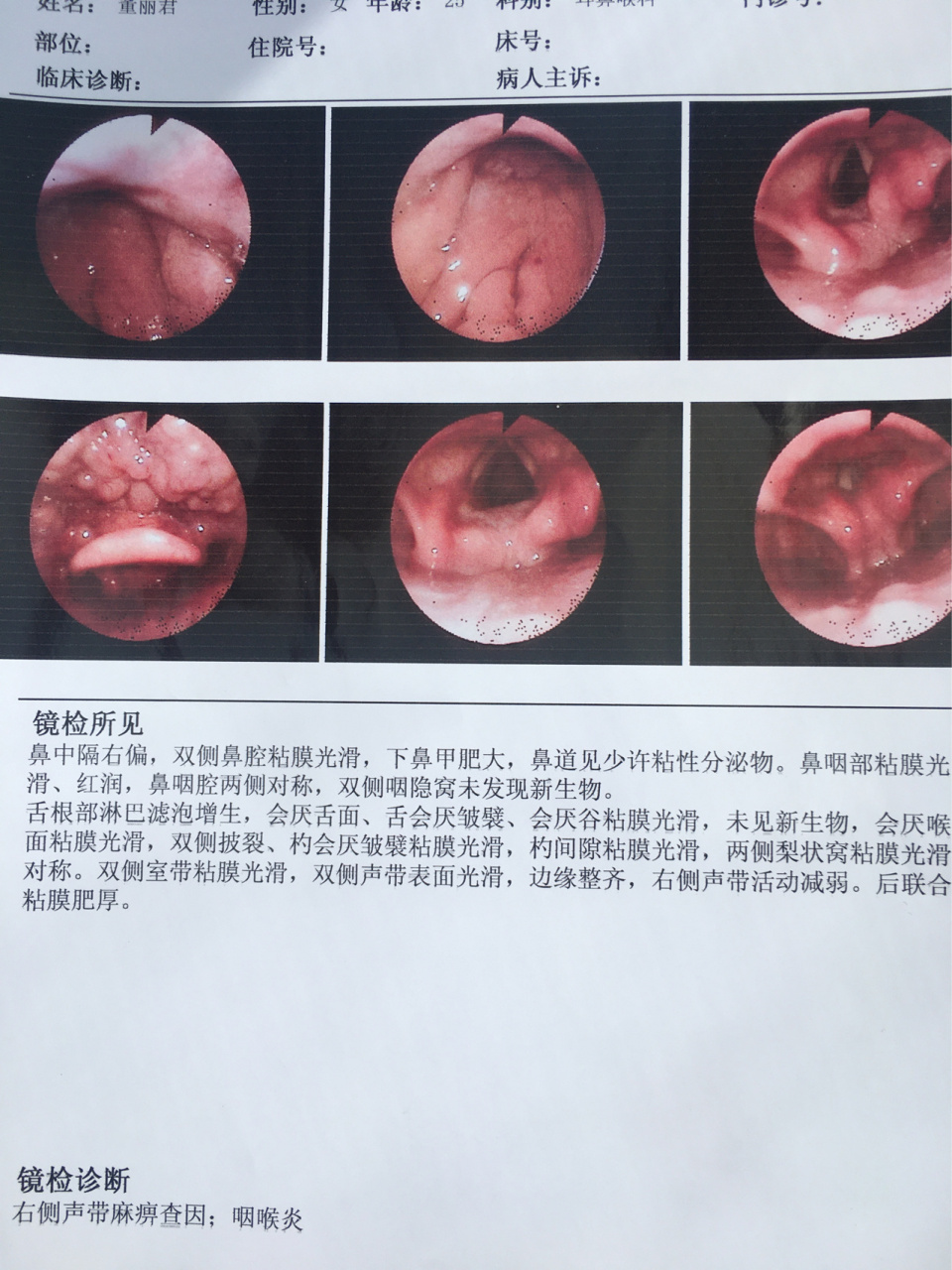 正常鼻内镜鼻咽部图片图片