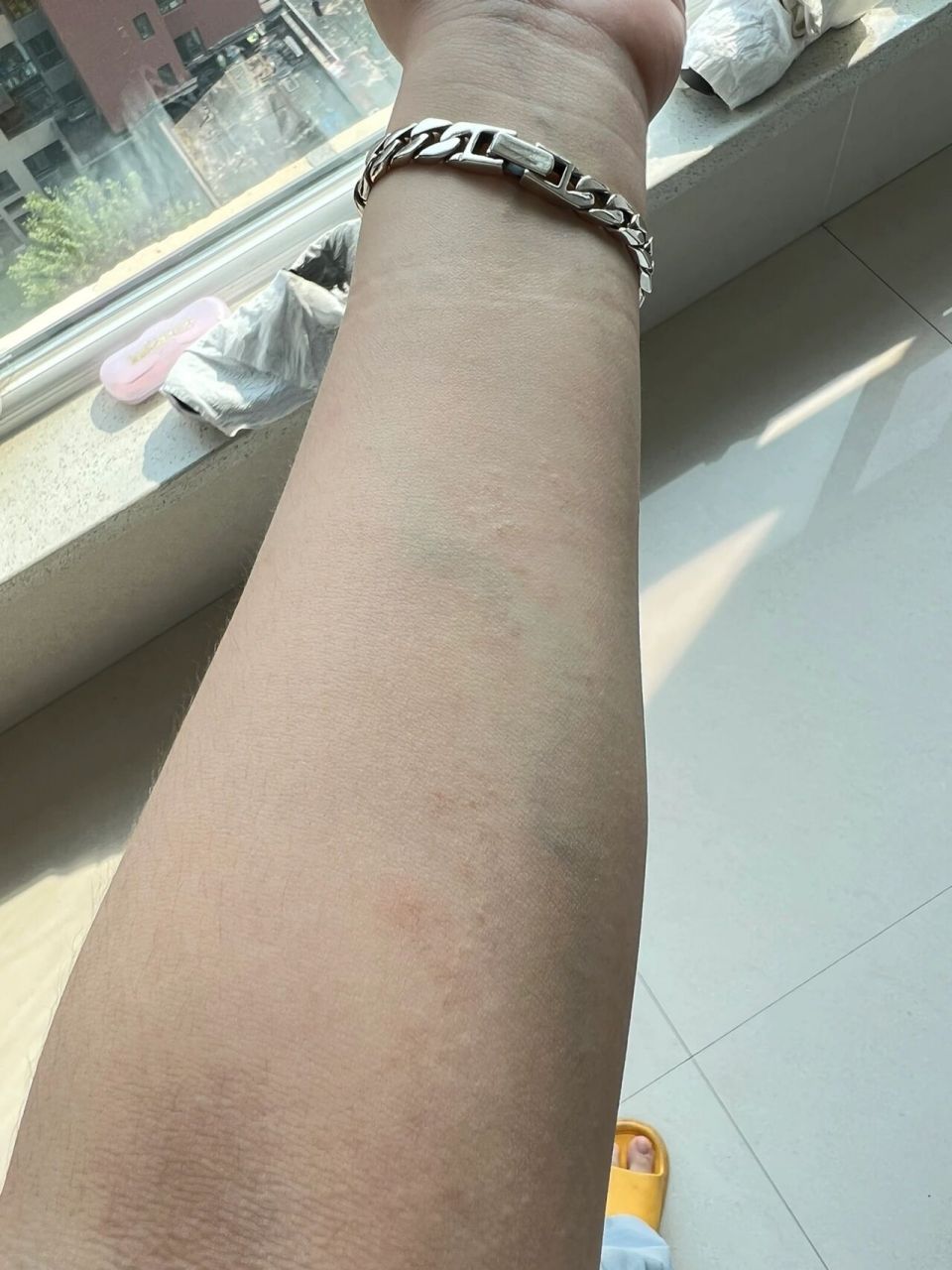 线状苔藓 小伙伴们没有像我这样,胳膊内侧起了很多小疙瘩,嘟嘟赖赖的