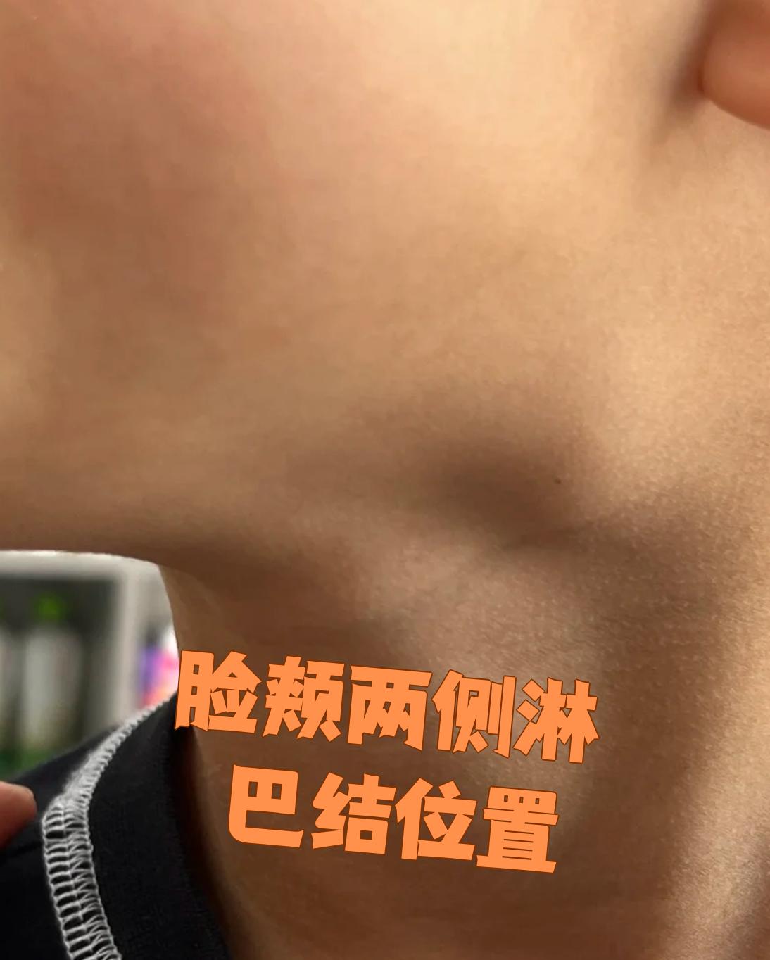 脸颊两侧的淋巴结主要分布在耳前耳后和下颌