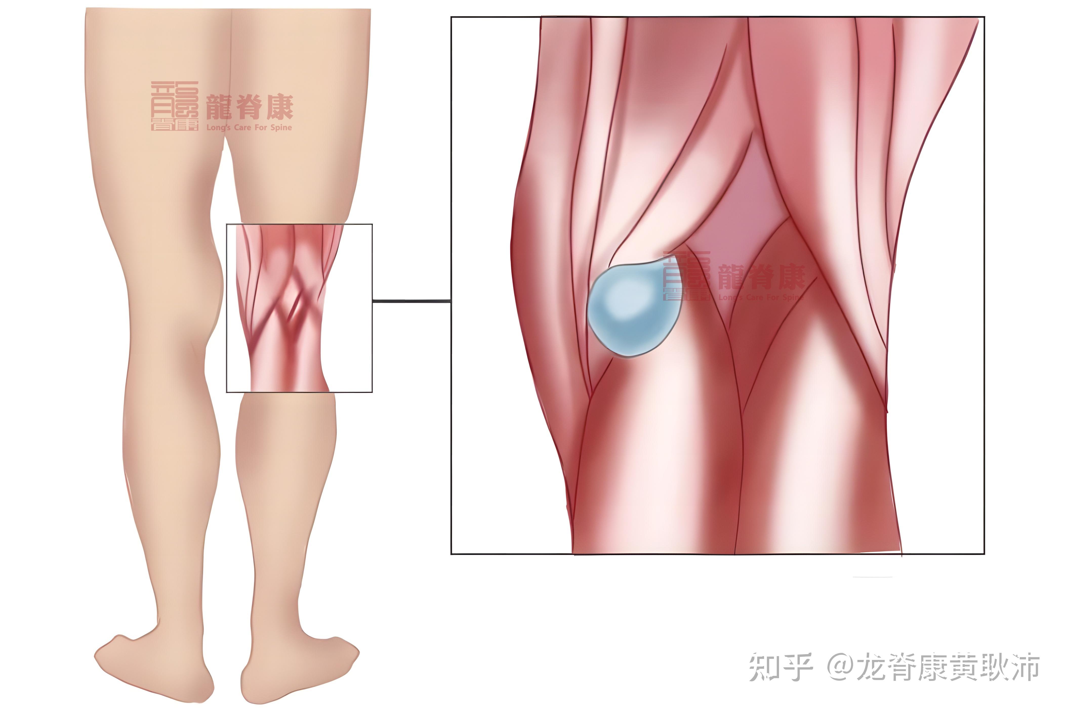 腘窝囊肿切口入路图片