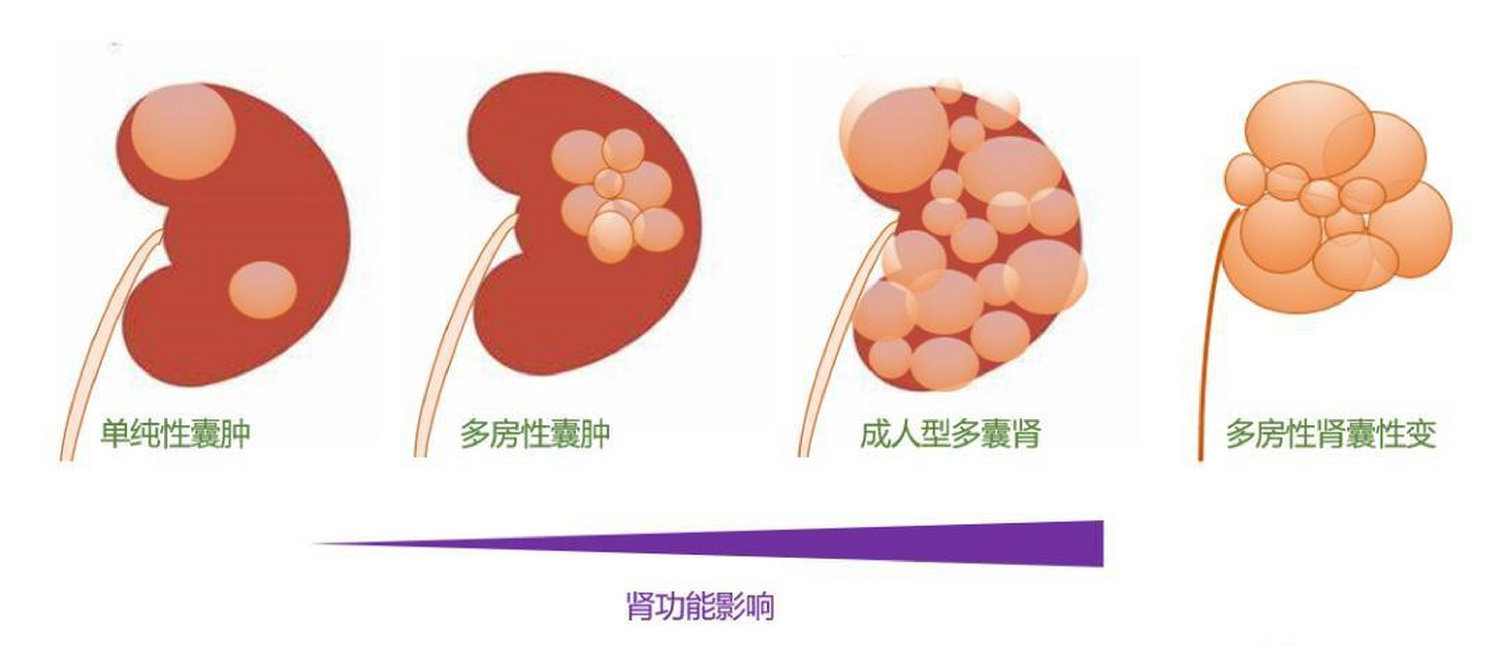 什么是肾囊肿---1 肾囊肿是一种非常常见的肾脏疾病,是指肾脏内出现