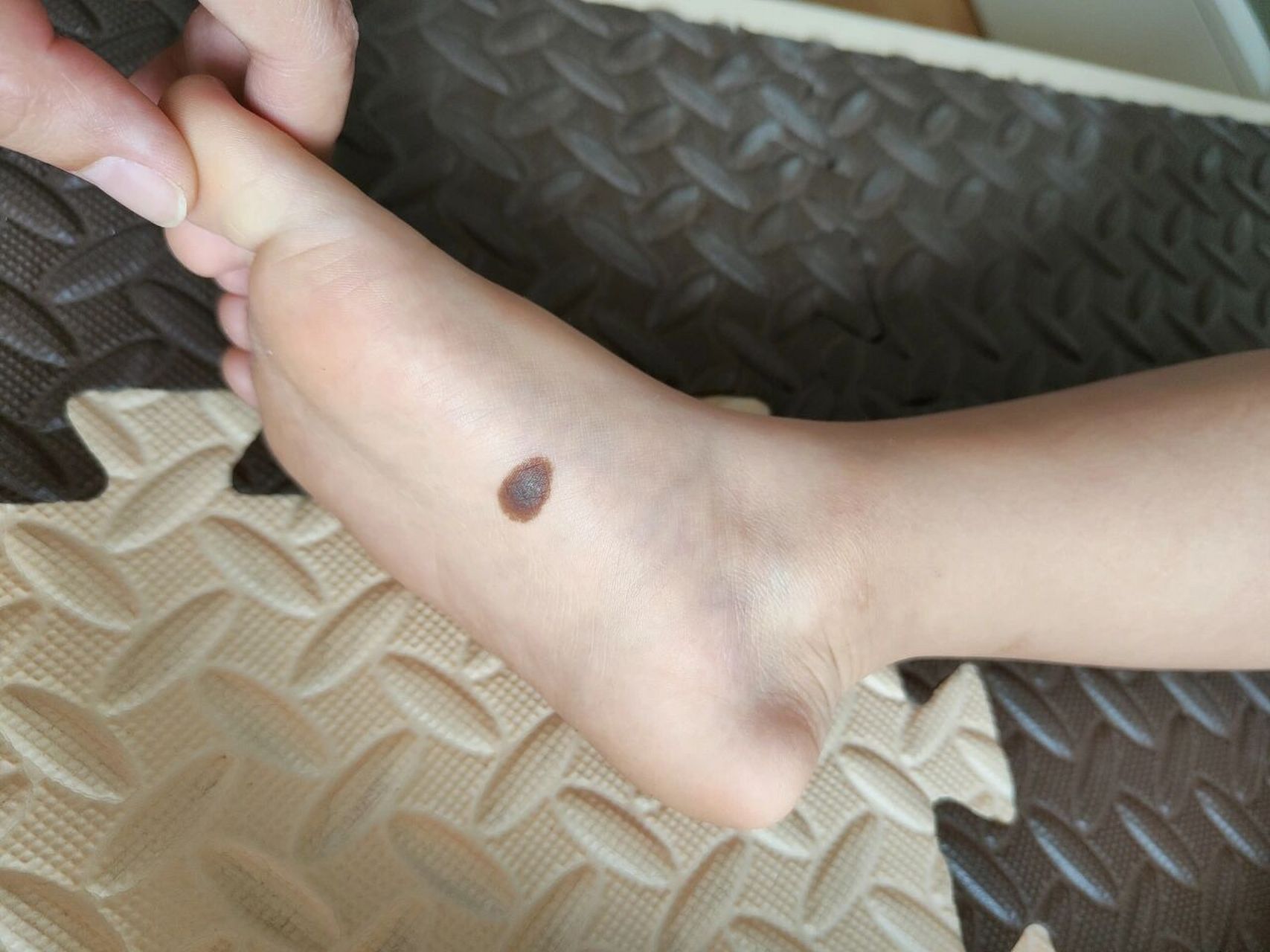 脚底长黑色素瘤图片