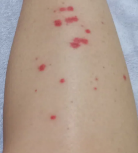 流鼻血且大腿上有红点怎么回事怎么办?