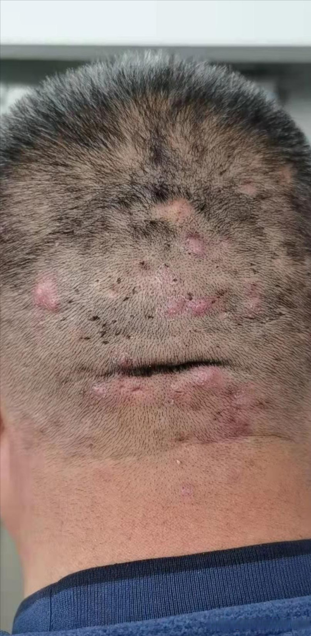 今天复诊了一位46岁的男患者,他已经忍受毛囊炎7年之久.