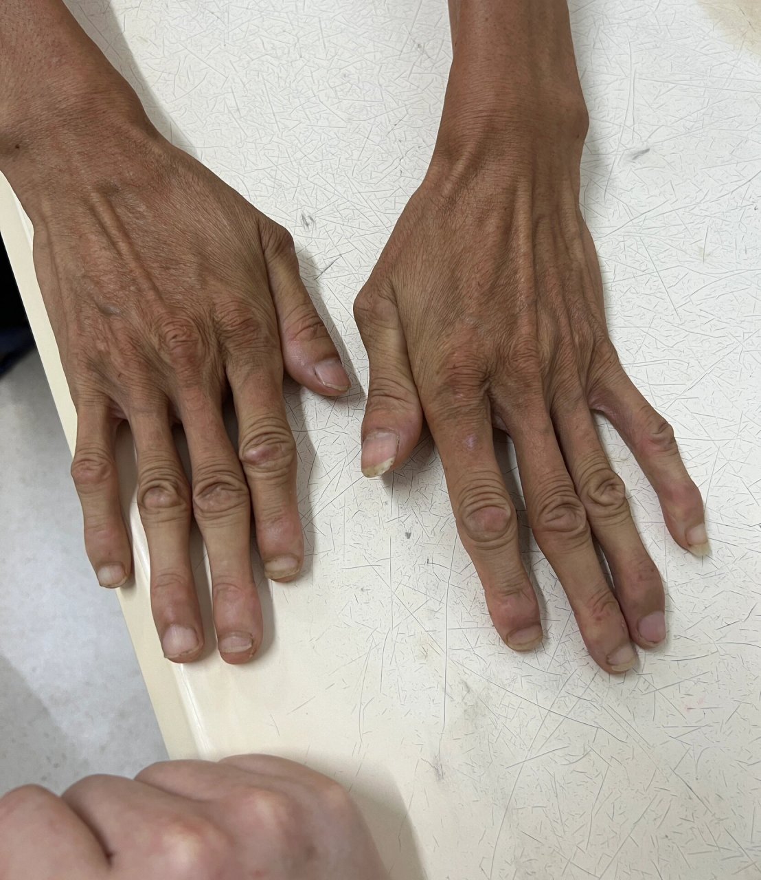 马凡综合征 患者自诉,他的外婆,妈妈,他自己以及他女儿都是"马凡综合