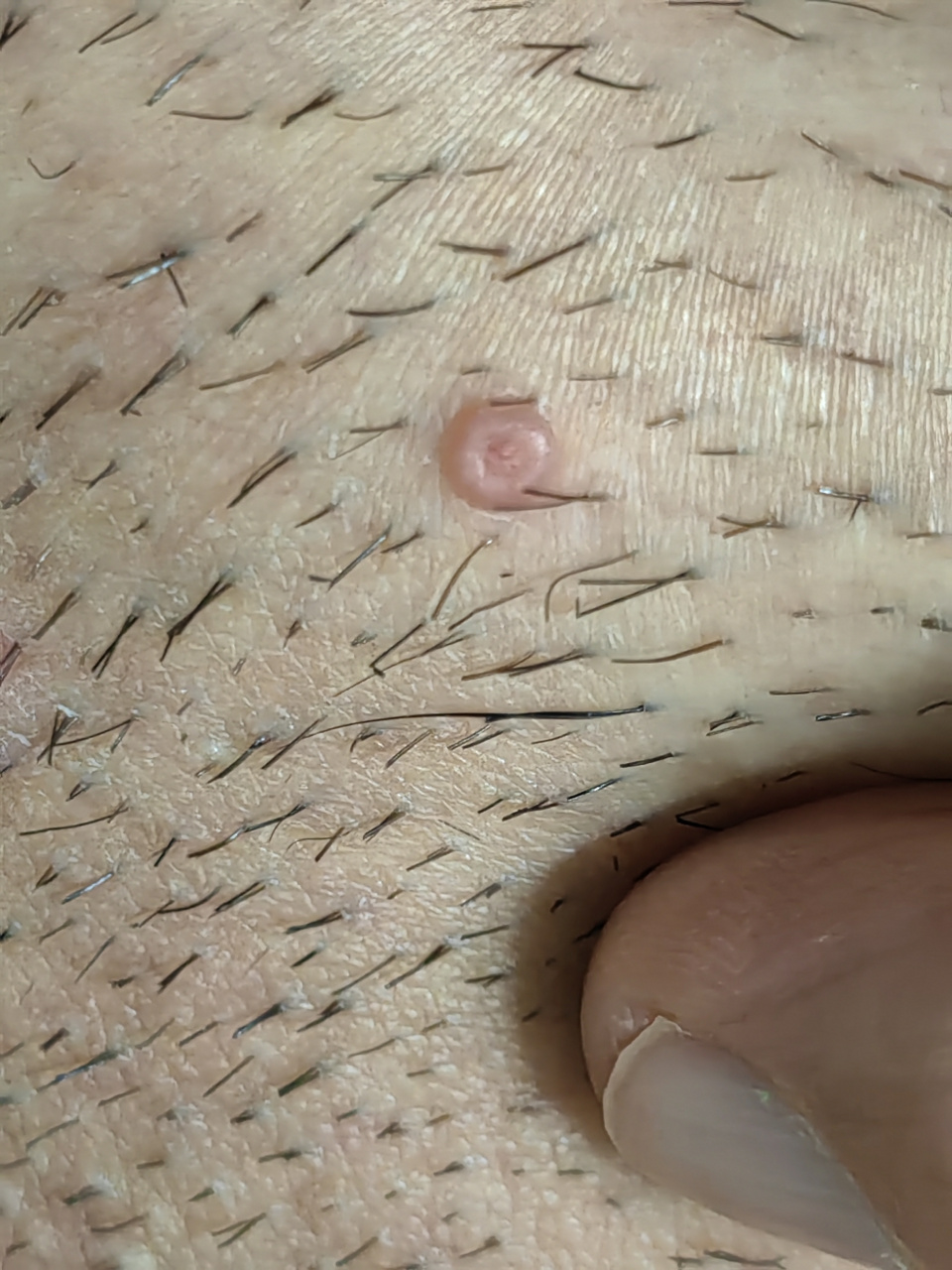 阴部传染性软疣症状 #传染性软疣