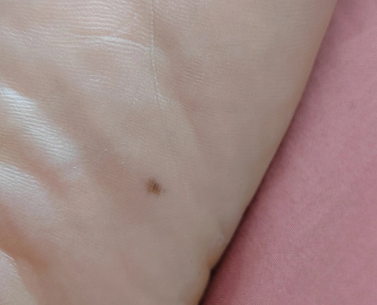 脚底长这样的黑点,需要现在就去切除吗