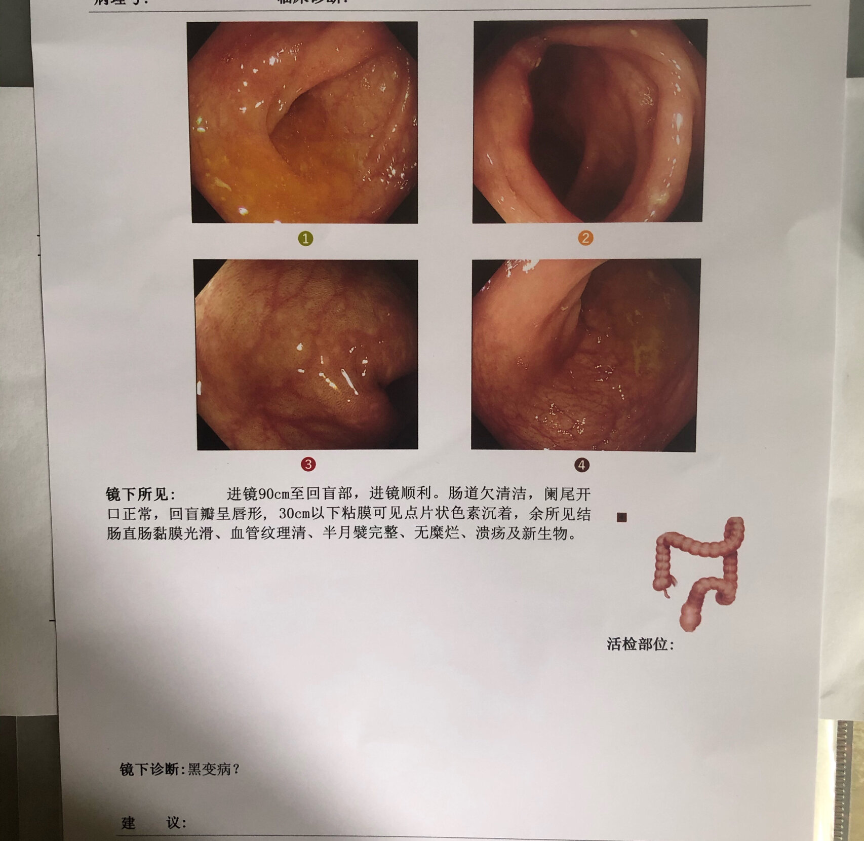 改善黑肠之路～ 去年七月份做的肠镜 减肥吃泻药弄