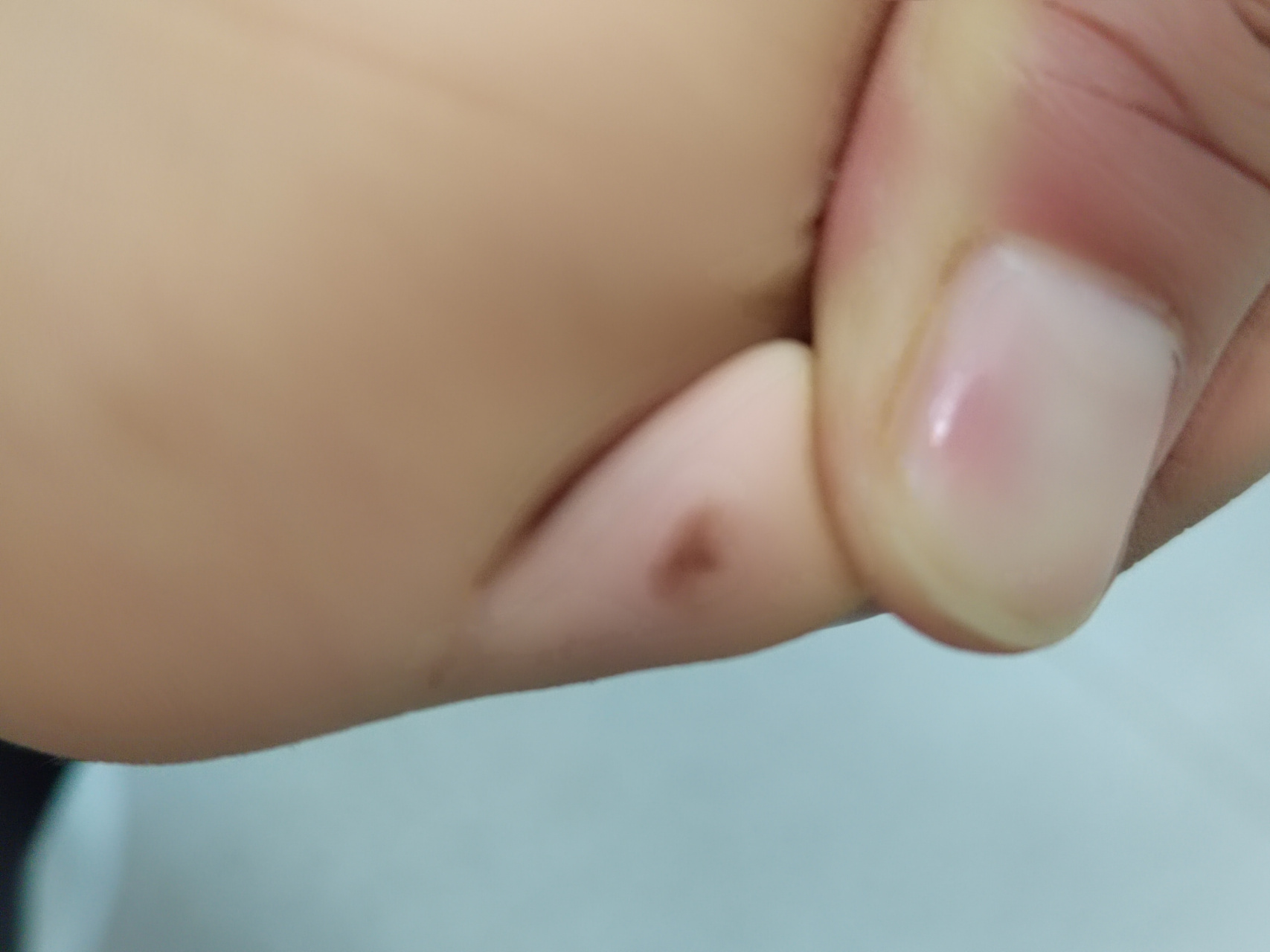 儿童脚趾色素痣,#解决皮肤问题专注皮肤美容# 手术切除比较好#色素痣