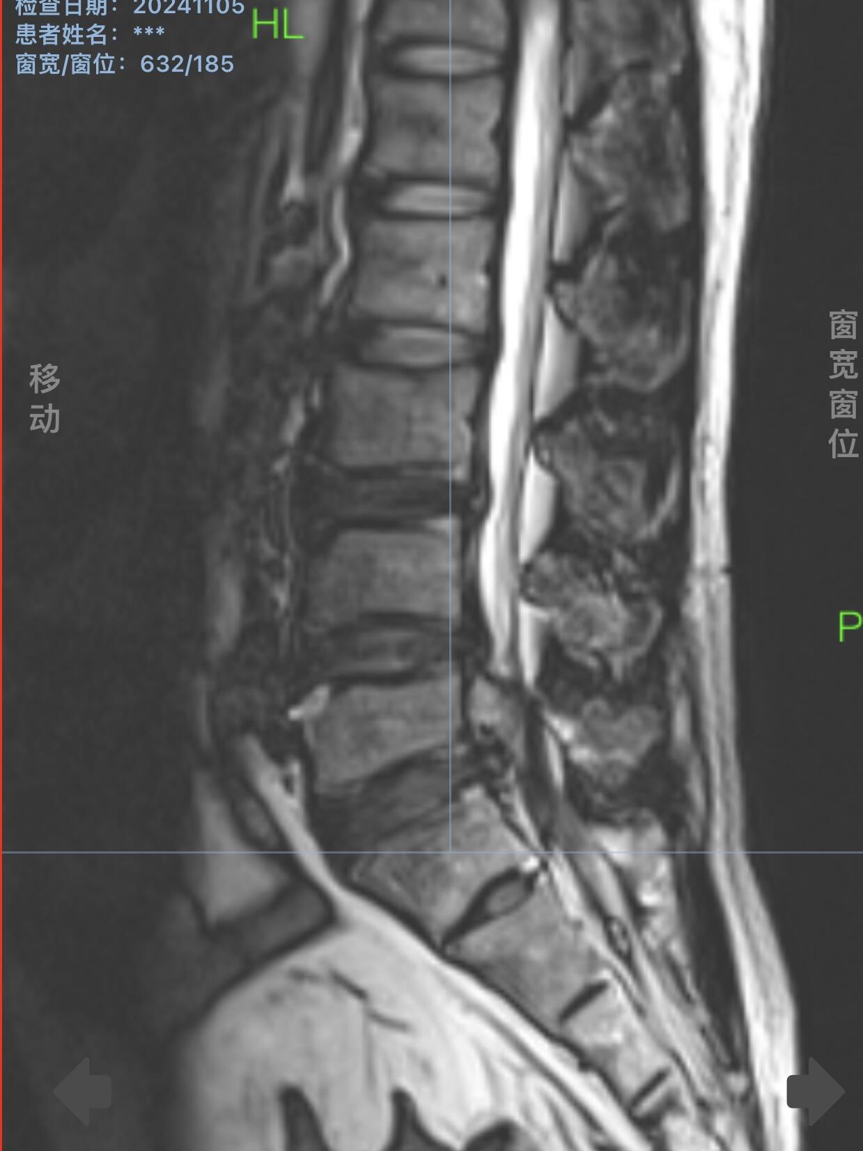 需要增强核磁共振检查.脱出也能很容易局麻微创内窥镜解决