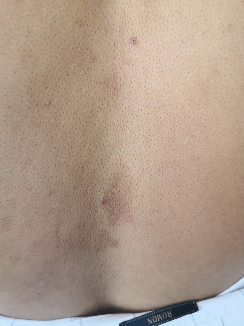 背部片状斑块苔藓样变皮疹考虑特应性皮炎的诊断