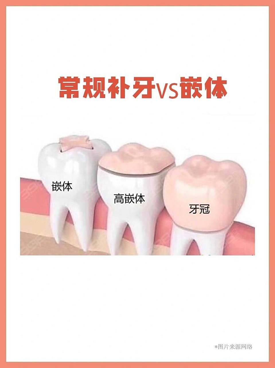 补牙时,推荐的嵌体是什么?