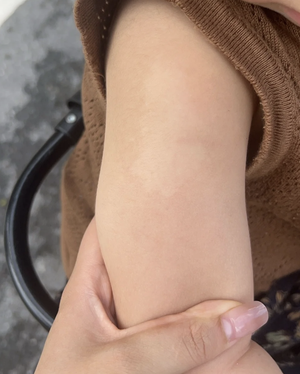 胳膊出现白色斑块,常见原因有白色糠疹,白癜风和斑状白化病,具体