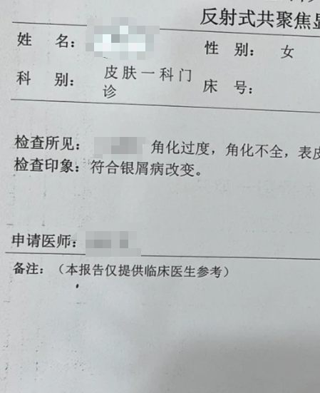 身上长圆圈癣但不痒,可能是寻常性银屑病,玫瑰糠疹或多形红斑的表现
