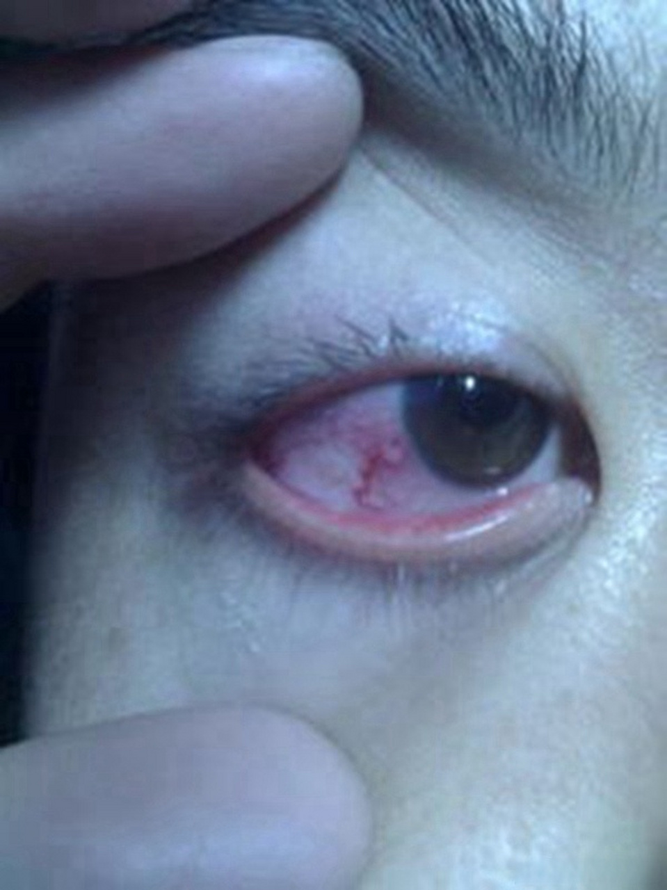 眼健康光明计划# 角膜炎要比结膜炎严重,主要症状为眼睛疼,围绕黑