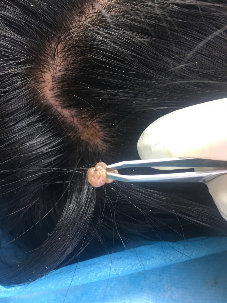 菜花疣 头皮部的疣,最早从外观上看可能就是皮赘样的小突起,但由于