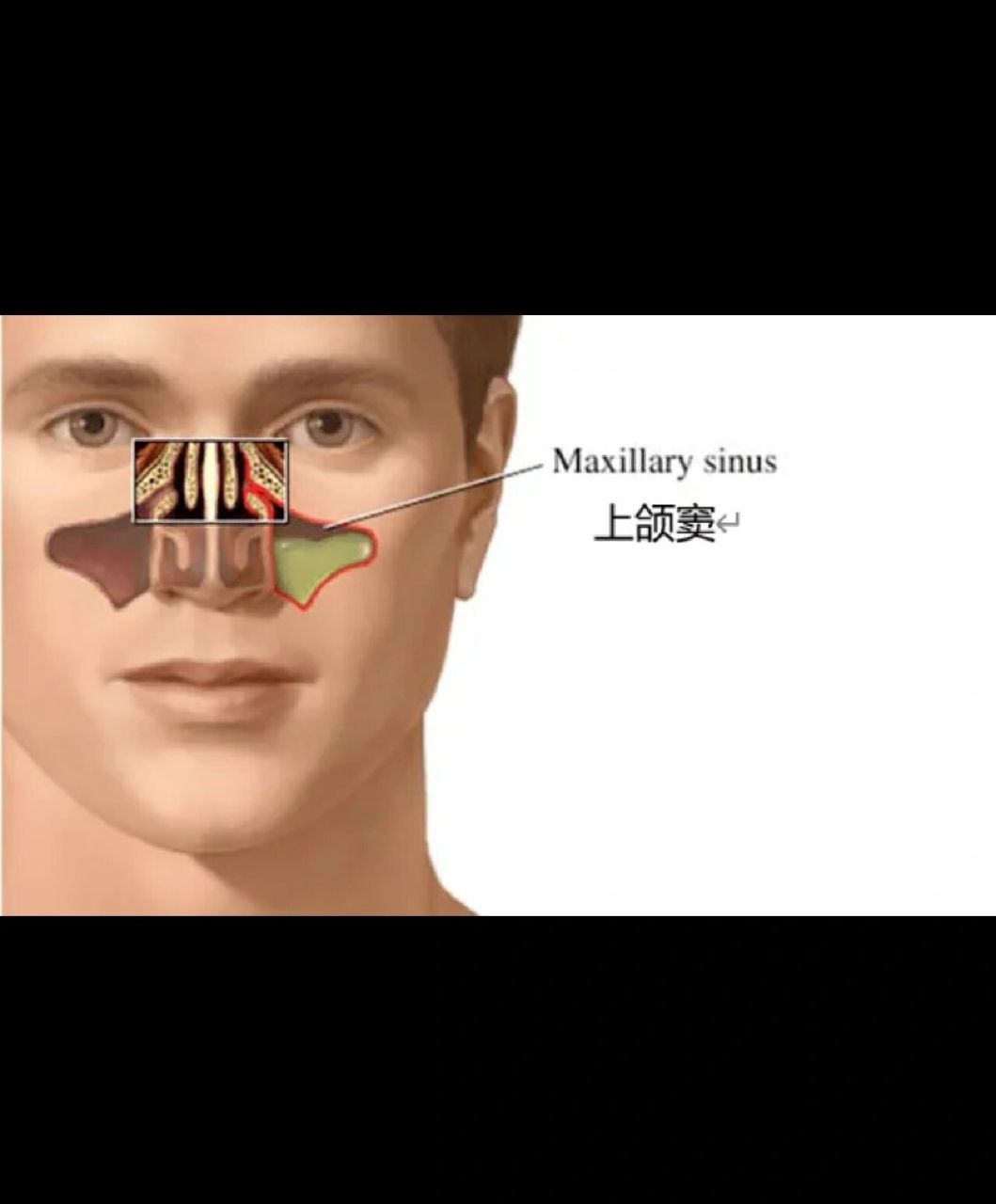 上额窦炎(下) 穿刺完说说会不会复发 穿刺完太阳穴,脸颊骨有时候一阵