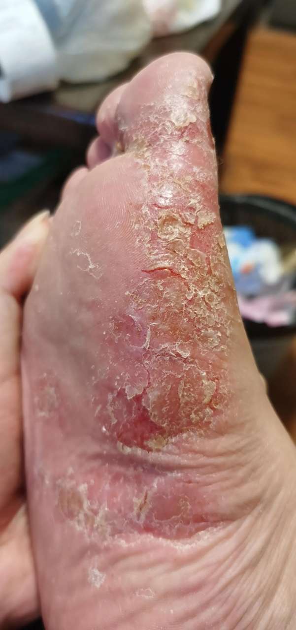 一开始觉得忍忍就过去了,半个月过去还未好,就买