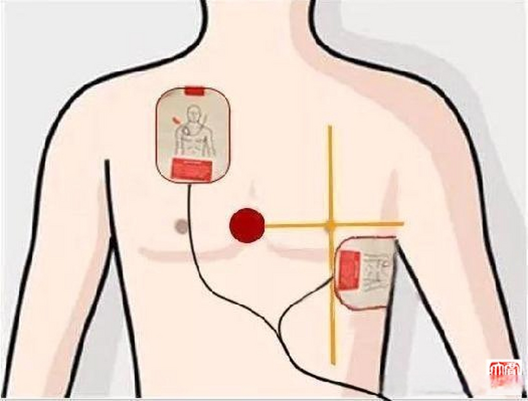 使用aed(自动体外除颤器)时,贴电极片的正确位置.