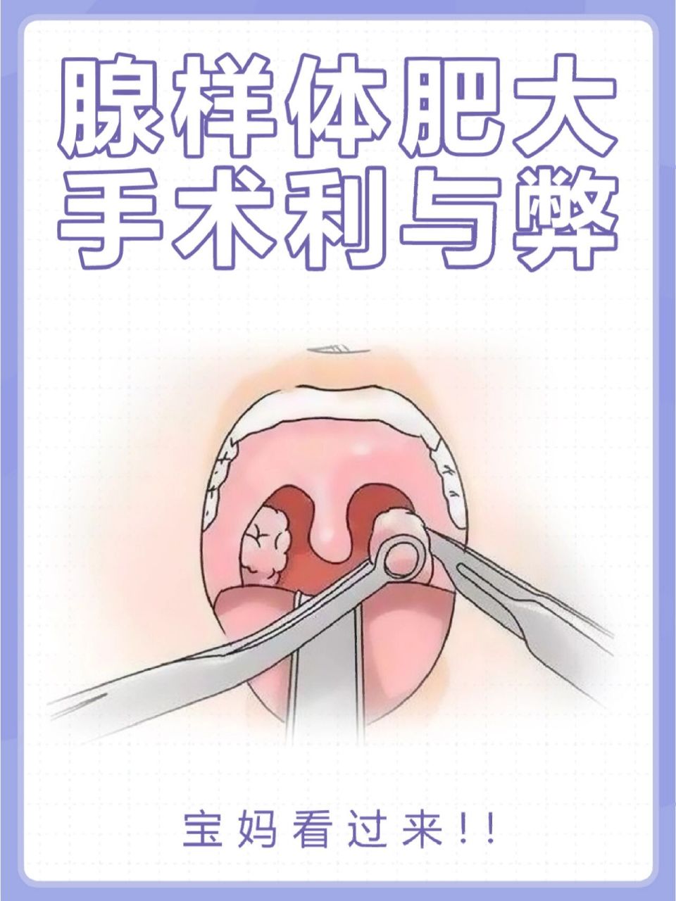 腺样体肥大手术利与弊,宝妈看过来6015 95普及一下腺样体手术的
