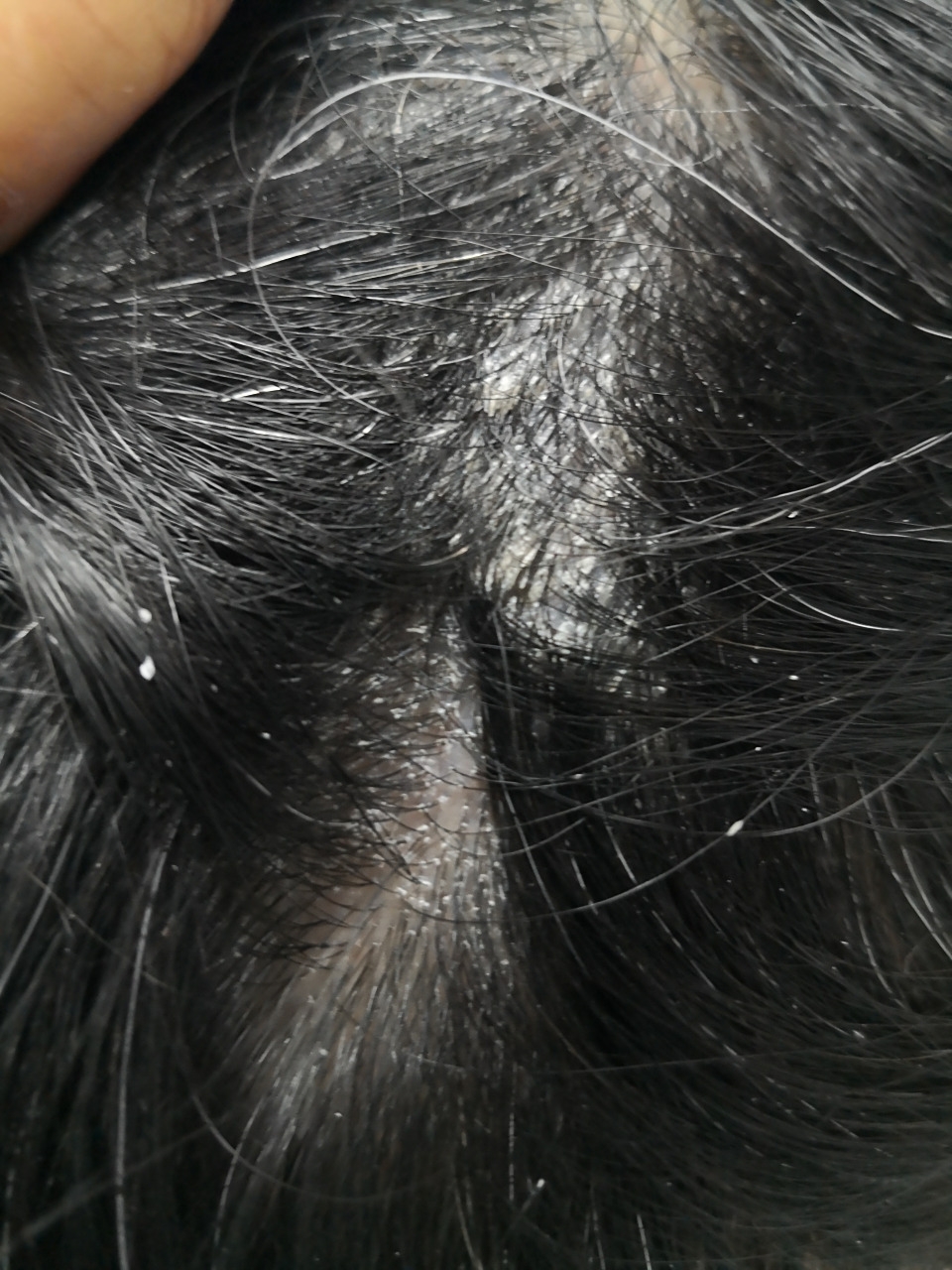 头皮粉末样脱屑.马拉色菌阳性!