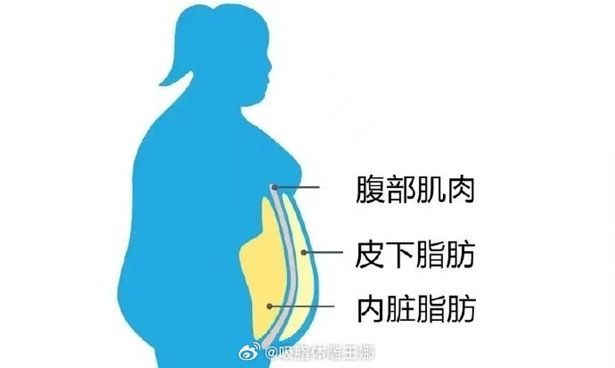 根据堆积部位不同,人体身上脂肪可分2种:内脏脂肪和皮下脂肪 内脏