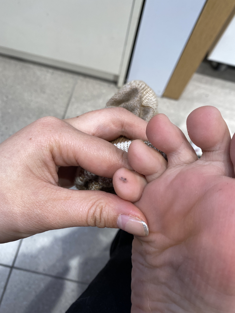 脚趾这颗痣长了很多年 脚趾这颗痣什么时候长的记不清了,但肯定肯多年