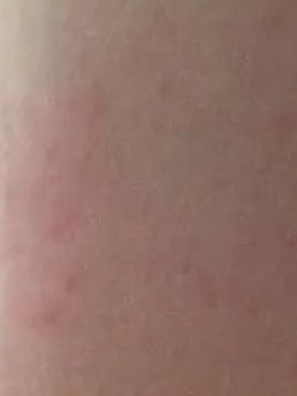 打了乙肝干扰素 你的皮肤起红疹子吗 张女士今年31岁,注射了乙肝