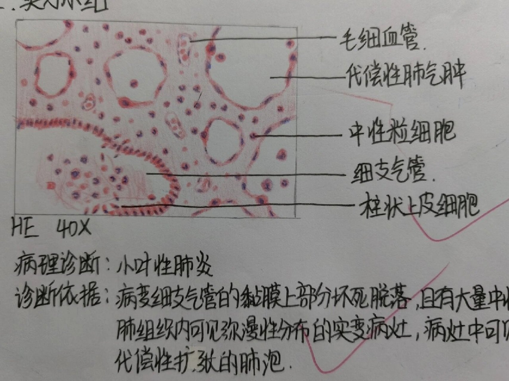 病理绘图 病理学红蓝铅笔绘图 p1小叶性肺炎 p2鳞状细胞癌(角化珠) p3