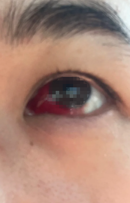 宝宝眼睛里出现红色血点,最常见的原因是结膜下出血