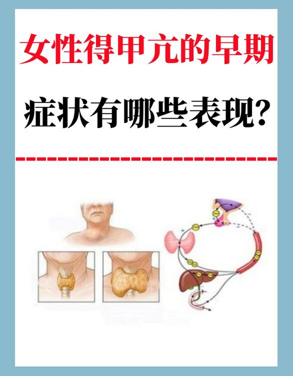 女性得甲亢的早期症状有哪些表现?