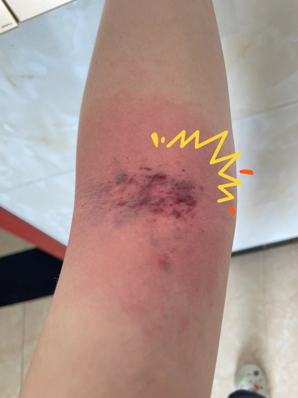 拍打手肘窝可以排毒吗?