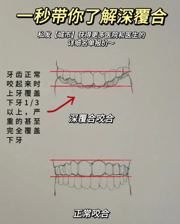 牙齿深覆合面相图片