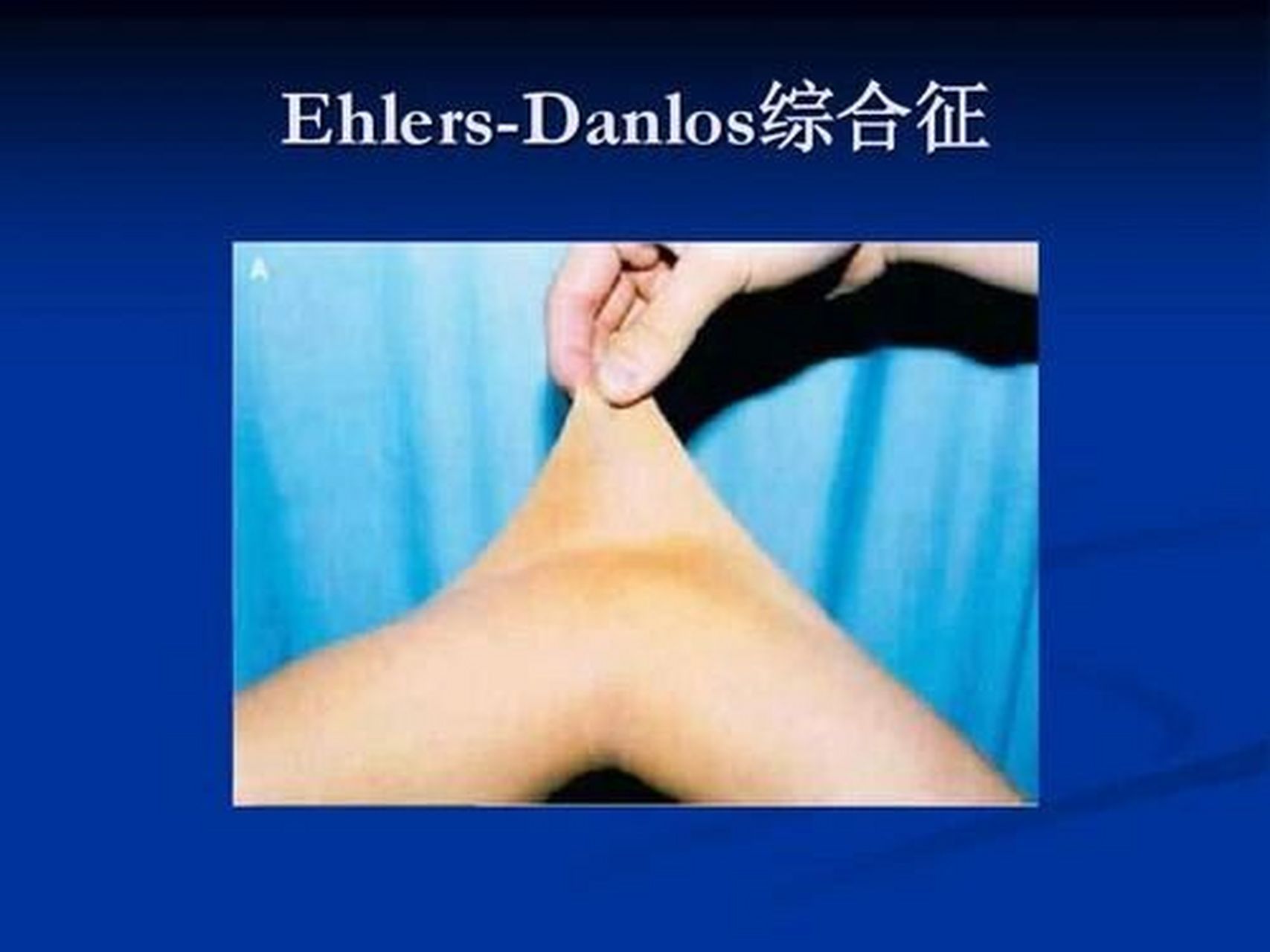 ehlers-danlos综合征图片