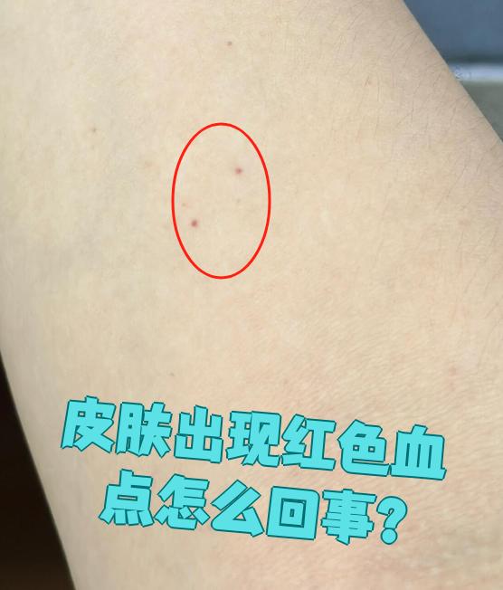 皮肤出现红色血点怎么回事?